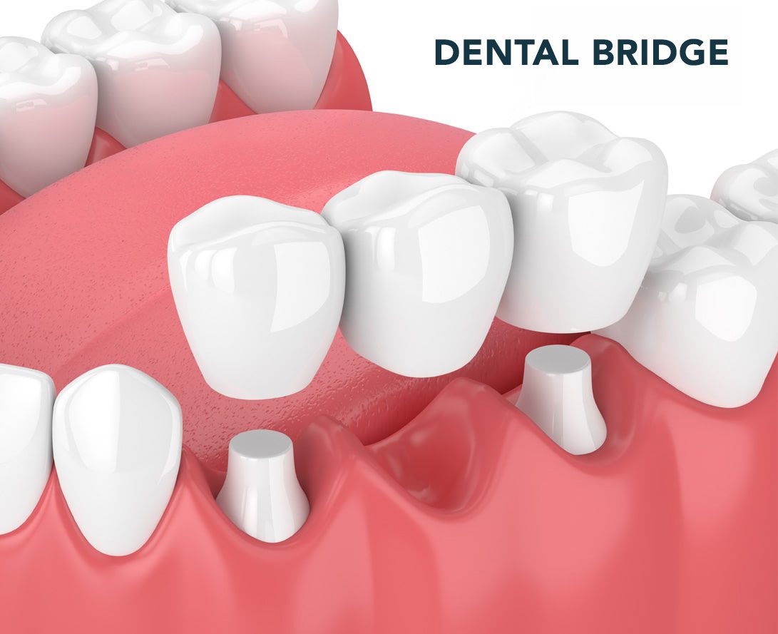 Dental bridge replacing a missing tooth