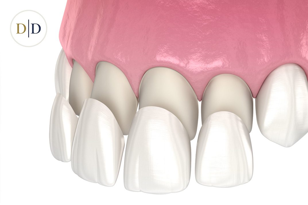 Porcelain veneers being fitted to upper front teeth